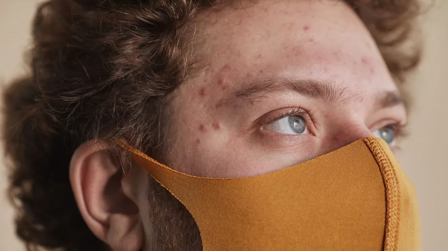 Over-Drying Acne Formulas Inflame Skin