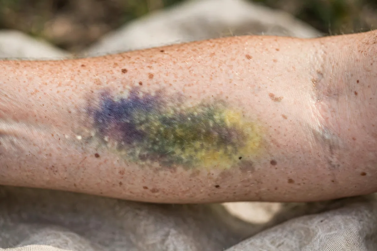 Close-up of a healing bruise on a forearm showing purple, green and yellow tones